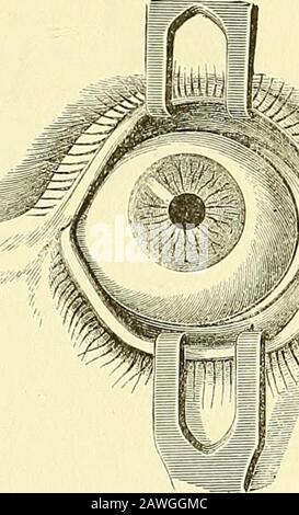 Les éléments de l'anatomie de Quain . la peau, et celui de l'organe de goût avec la langue. L'ŒIL. L'organe de vision, strictement parlant, se compose uniquement du lobe de boule orglobe de l'oeil ; mais liés à l'extérieur du globe oculaire sont les muscles, les nerfs, et les vaisseaux sanguins, décrits ailleurs, ainsi que d'autres partsspécialement destinés à sa protection, et connus sous le nom d'appendices de l'oeil (tutamina oci), dont un compte sera d'abord donné. LES PAUPIÈRES ET LA CONJONCTIVE. Les paupières {palpelrce) sont des parties mobiles du tégument, la force-ensachée vers leurs marges par une fine couche de fibro dense Banque D'Images