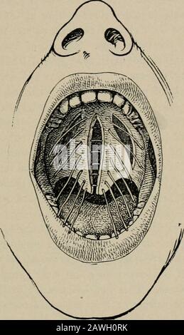 Chirurgie opératoire, pour les étudiants et les praticiens . ocess. Ce processus, qui est situé derrière et à l'intérieur de la dernière dent molaire, est veryaisément ressenti. Ces incisions passent par toute l'épaisseur du palais ofsoft, de derrière l'avant, et divisent les tendons de l'ascenseur et du tenseur palati près du processus hamulaire, où le théys'est répandu dans le palais doux. En règle générale, il ne sera pas nécessaire de faire ces incisions latérales, surtout si des soins ont été pris pour détacher complètement le palais mou de la bordure postérieure de l'OrERATIOXS POUR HARELIP, FENTE PALATINE, ETC 191 palais dur an Banque D'Images