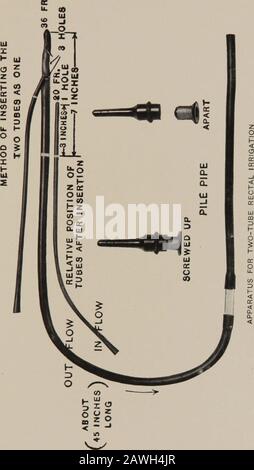 Soins infirmiers pratiques : un livre de texte pour les infirmières . /2 pintes s'écoulent dans le rectum en deux heures. (2) le débit doit être régulatentièrement par la hauteur de l'irrigateur, jamais par l'utilisation de pinces, pour toute restriction du tube interfèrent volontairement avec le passage libre de la solution de l'intestin dans le tube et le fera flower du rectum dans le lit. Il n'est pas possible de spécifier une hauteur exacte pour le théirrigateur; en général, elle est nécessaire à. Enemata et Les Injections Intestinales 373 se situent entre 4 et 18 pouces au-dessus du patient, mais la force nécessaire varie selon les individus A. Banque D'Images