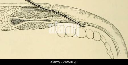 Chirurgie opératoire . Fi(i. 731.—méthode des désectes. 564 CHIRURGIE OPÉRATOIRE. Fig. 732.—la méthode de Richalots a été aspirée dans le canal fait par l'instrument et conservée jusqu'à ce que le canal apatent soit formé par lequel la salive coulait, suivie d'une healingde l'ouverture externe. Méthode de van Bureiis.—Van Buren a guéri un cas obstiné en turningl'extrémité du conduit dans la bouche de la manière suivante: Un petit probawas introduit dans le conduit de sans pour le stabiliser pendant la dissection et indiquer sa situation afin d'empêcher de le couper. L'extrémité distale du conduit a été exposée pour une courte distance en voiture Banque D'Images