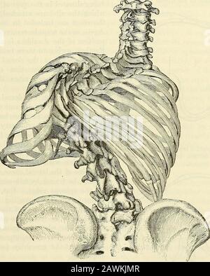 Un système de chirurgie : théorique et pratique . ne devient plus aiguë, la rotation ou la torsion qui l'accompagne est augmentée ; et le renflement au côté convexe est augmenté à un degré correspondant. Cette condition est miuch plus visible dans la dorsale (voir fig. 95) que la région lombaire; pourtant des cas ont été rencontrés, dans les reins, où la rotation des vertèbres sur leur axe long n'a pas diminué d'un quart de cercle dans son circuit; et dans laquelle les vertèbres au niveau de la principaubend, lorsqu'on les regardait du dos, étaient vues dans le profil au lieu de l'arrière. Un autre éfiect a produit u Banque D'Images