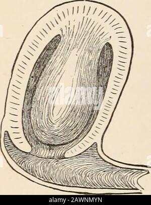 Archives de médecine : une revue bimensuelle consacrée aux communications originales sur la médecine, la chirurgie et leurs branches spéciales. . gg, et avoir un attachement sessile atle fundus. Le diagramme suivant illustre l'état des choses : cette masse était en creux à son extrémité inférieure et les symptômes du cancer ont été développés. En le saisissant avec un vulsellum fort, et en le faisant glisser avec beaucoup de difficulté, Ipassa l'ecrateur jusqu'à Ipourrait et le coupe. Mais je suis d'avis qu'en dépit de tous mes efforts, le point le plus élevé n'avait pas été atteint, et qu'au moins un quart de la thétumomie Banque D'Images