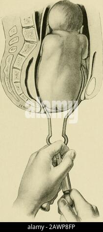 Midwifery opératoire : un guide des difficultés et des complications de la pratique midwifery . Fig. 18.— Impaction de la Culasse—livraison Au moyen du congé. Aspect de la culasse puis pivoté en position, le point est guidé sur la cuisse. PRÉSENTATIONS de la breech 83 Certains obstétriciens se sont exprimés en faveur de la forcepsine impacté la breech, bien que la plupart des écrivains soient opposés à la fleche traiter-. Fig. 49.—Action De La Culasse—livraison Par forceps. Ment (Fig. 49). Diverses tentatives ont été faites pour concevoir des pinces adaptées à la breech, mais elles se sont toujours avérées insatisfait Banque D'Images