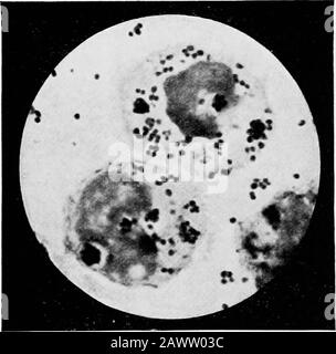 Les fondamentaux de la bactériologie ; être une introduction concise et systématique à l'étude des bactéries et des microörganismes alliés . Themenococcus est très sirmlar, mais est facilement cultivé et n'est pas susceptible d'être foimd dans les mêmes sécrétions que les gonococcus. Micrococcus citreus, albicans et subflavus, décrits par Bumm, sont tous Gram positifs et se développent facilement sur gélatine et sur gélose. Le gonocoque se distingue de tous ces micro-cocci similaires par les tests énumérés ci-dessus. Ces caractéristiques, prises en toto, forment suffisamment d'interieurpour sa reconnaissance prête, et comme c'est souvent une question sérieuse Banque D'Images