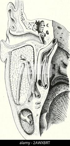 Thérapeutique chirurgicale et technique opératoire . Fig. 111.— Enucléation d'un Gland Lymphatique de la région Parotide avec un spoon Volksmanns. Banque D'Images