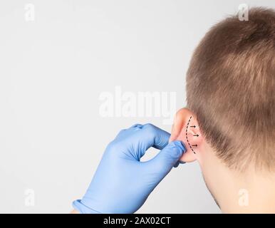 Un médecin chirurgien plastique examine l'oreille d'un patient masculin pour une opération d'otoplastie. Le concept de suppression de la surdité, de l'espace de copie, de la procédure Banque D'Images