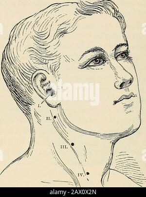 La pathologie et le traitement chirurgical des tumeurs . 6L4 PATHOLOGIE ET TRAITEMENT DES TUMEURS. Fig. 443.—diagramme indiquant les orifices des fistules branchiales persistantes (après Sutton). Le premier point de départ des kystes branchiaux doit nécessairement répondre à la cor avec l'emplacement de l'un de ces clefts branchiaux, et cHnicalobservation a démontré que les branchialcystes sont le plus fréquemment trouvés dans la région des deuxième et troisième clefts, dans la vicinitydu larynx et du pharynx, et dans l'intimidation avec la gaine des grandes vessesdu cou, en contradiction avec les dermoidkystes sur le Banque D'Images