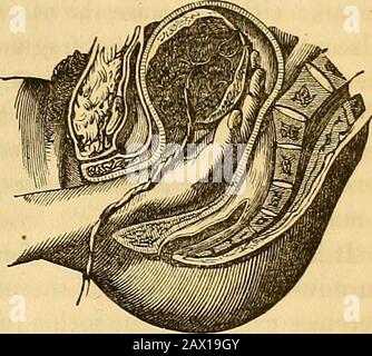 Un traité théorique et pratique sur la midwifery : y compris les maladies de la grossesse et de la parturation et les attentions requises par l'enfant de la naissance à la période de sevrage . être atteint et combaté comme ils se présentent par les mesures appropriées. Notre propre opinion est que le cours de Levret, de Baudelocque, de Desormeaux, et de M. P. Dubois, est le mieux adapté aux cas de ce genre; c'est-à-dire, après des ravages les différents moyens dont nous avons parlé, d'introduire la main dans la cavité utérine, en suivant le cordon, qui est alors le meilleur guide jusqu'à la pla-centera. Si cela avait été déchiré, t Banque D'Images