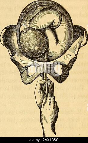 Un traité théorique et pratique sur la midwifery : y compris les maladies de la grossesse et de la parturation et les attentions requises par l'enfant de la naissance à la période de sevrage . cas, nous havenothing à faire mais d'attendre l'évolution spontanée, si l'enfant vit; mais dès qu'elle est morte, nous devons rapidement soulager la mère des conséquences dangereusement dangereuses d'un travail prolongé. Pour amputer le bras dans de telles circonstances est tout à fait inutile, becauseits présence ne peut pas incommode l'opérateur; et, en outre, il peut afterwardsprouver très utile en favorisant les tractions; il est sur le th Banque D'Images