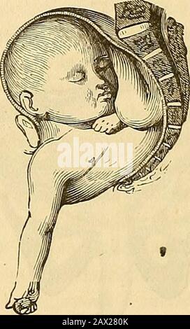 Un traité théorique et pratique sur la midwifery : y compris les maladies de la grossesse et de la parturation et les attentions requises par l'enfant de la naissance à la période de sevrage . Fig. 79. Position de l'enfant après la rotation, et juste au moment -quand le processus de déengagecommence.Fig. 80. La même position avec l'accouchement est plus avancée. Par conséquent, il s'agit de la période de déflexion ou de désengagement. Il a lieu aroundthe épaule, situé sous la symphyse comme un centre, et donc, si des lignes betracées de ce centre, se terminant aux différents points du côté des enfants, wes Banque D'Images