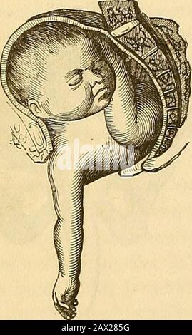 Un traité théorique et pratique sur la midwifery : y compris les maladies de la grossesse et de la parturation et les attentions requises par l'enfant de la naissance à la période de sevrage . forcé en masse dans l'excavation, sous l'influence des puissantes contractions utérines, mais l'épaule ne cand plus, parce qu'elle est arrêtée par l'essoufflement du cou; d'où la force expansive agit sur l'extrémité pelvienne, qui est plus pressée et moretoward le sol du bassin, et traverse toute la face antérieure du théacrum. Il repose ensuite contre, déprime et disprime de force le Banque D'Images