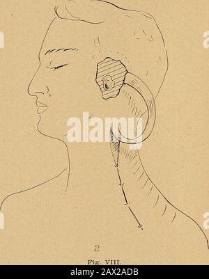 État actuel de la chirurgie plastique au sujet de l'oreille, du visage et du cou . Fig. VIII Volet tubulaire. Reconstruction externe de l'oreille (anglais). 16 beck: état actuel de la chirurgie plastique. Il y a un certain nombre d'autres procédures qui ont été développées, qui intéressent particulièrement les plastiques Maxillo-faciaux. Je havereférence pour les différents appareils, mais il y a aussi chaque cas exige des appareils particuliers construits. À cet égard, la Maitreswork shop était le meilleur que j'ai jamais vu, il a démontré l'importance de l'association d'un dentiste, mécanicienne et chirurgien plastique. Une caractéristique frappante pour moi Banque D'Images