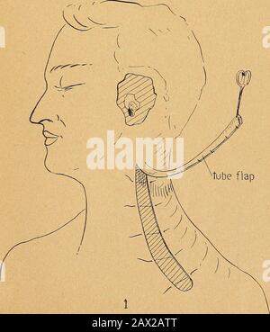 État actuel de la chirurgie plastique au sujet de l'oreille, du visage et du cou . stockage du Cartilage du cartilage (ANGLAIS) Fig-. VI Fig. VII. Fig. VIII Volet tubulaire. Reconstruction externe de l'oreille (anglais). 16 beck: état actuel de la chirurgie plastique. Il y a un certain nombre d'autres procédures qui ont été développées, qui intéressent particulièrement les plastiques Maxillo-faciaux. Je havereférence pour les différents appareils, mais il y a aussi chaque cas exige des appareils particuliers construits. À cet égard, la boutique la Maitreswork était la meilleure que j'aie jamais vue, elle a démontré l'importance de l'association d'un dentiste, moi Banque D'Images