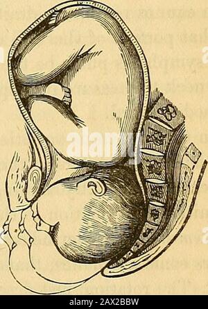 Un traité théorique et pratique sur la midwifery : y compris les maladies de la grossesse et de la parturation et les attentions requises par l'enfant de la naissance à la période de sevrage . pur-posely omis par crainte d'interrompre le régulièrement Vari0us degrés du désengagement , . 11111 de la tête (dans la même position), la description ; ainsi, Nous Avons Dit, que la tête com- occiput partant de plus en plus de la plendisation et descendit, mais que cette épaules, le mouvement de descente a été interrompu par la rotation; après quoi la descente?a été terminée, et en même temps la flexio Banque D'Images