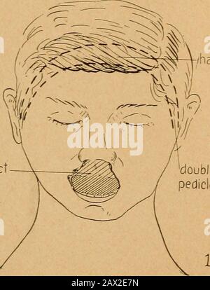 État actuel de la chirurgie plastique au sujet de l'oreille, du visage et du cou . puckennijof flapressected Fig. II. Défaut de lèvre. Lambeau double pédicelle Fig. III Reconstruction de la lèvre supérieure (français). Be;ck: État actuel oe chirurgie plastique. 11 Fig. III Défauts de la haute lèvre: Les trois illustrationssuivantes montrent une procédure très nouvelle et satisfaisante employée par Sibeloet ses associés à l'hôpital Valde gras, à Paris. Bien sûr, il ne s'applique qu'aux mâles. Fermeture de scalp&gt; ^ défaut double pédicelle flapin à la place de la lèvre Banque D'Images