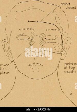 État actuel de la chirurgie plastique au sujet de l'oreille, du visage et du cou . 10 beck: État actuel oe chirurgie plastique. Deectclosed. Puckennijof flapressected Fig. II. Défaut de lèvre Banque D'Images