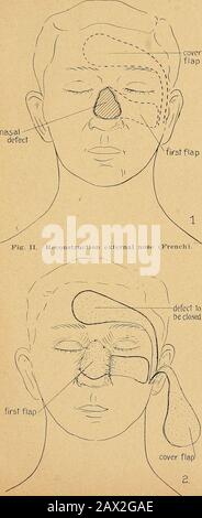 État actuel de la chirurgie plastique au sujet de l'oreille, du visage et du cou . Wolf greffon pédicelle (turnedbacK Pig-. Hôpital de Vichy et il préfère à toute autre procédure dans defectsparticulièrement approprié pour elle. Parfois, il y a planté un morceau d'ofbone ou de cartilage sous le rabat du front plusieurs semaines avant que la pâte soit transplantée. Un point très intéressant dans le Maitresoperation est le fait qu'il s'agit d'une procédure en une seule étape. Il y a d'autres faits importants et intéressants à ce sujet et maniyautres de ses opérations qui seraient de la valeur de décrire ici, butthis n'est pas le but de mon papier. Banque D'Images