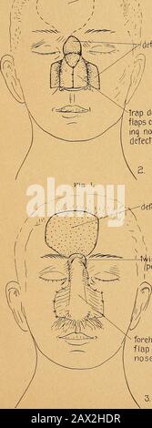 État actuel de la chirurgie plastique au sujet de l'oreille, du visage et du cou . Fig. I. reconstruction du nez (Eng-lish). En raison du service particulier que j'ai eu, j'ai été autorisé à visiter de nombreux hôpitaux militaires dans les pays alliés, en particulier en France, en Italie et en Angleterre et, par conséquent, a eu une grande opportunité de voir le bien aussi bien que le mauvais. J'ai choisi certaines des méthodes et j'ai pris la liberté de les illustrer sans aucune idée de publier d'autres travaux de mens avant leurs articles d'origine, ni que quiconque, en particulier ceux qui ne connaissent pas le plastim^ork, sera en mesure d'exécuter des Banque D'Images