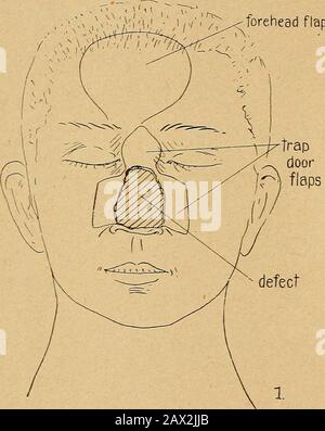 Le statut actuel de la chirurgie plastique au sujet de l'oreille, du visage et du cou . était vrai dans mon observation d'autres travaux.Il est très regrettable que dans mon service ainsi que celui de manyautres hommes, les résultats des opérations secondaires ne pouvaient pas être suivis, en raison du fait que les patients sont transférés à leurs maisons respectives, pour plus d'observation ou d'opérations. Il y avait cependant de nombreux endroits où j'ai eu le plaisir d'observer des cas qui avaient été exploités sur tout le chemin de l'oneday à quatre et demi ans avant ainsi que de voir différent t) BECK : ÉTAT ACTUEL DE LA CHIRURGIE PLASTIQUE. Banque D'Images