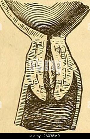 Un traité théorique et pratique sur la midwifery : y compris les maladies de la grossesse et de la parturation et les attentions requises par l'enfant de la naissance à la période de sevrage . broche, plutôt que celle d'un cône, qui avait précédemment. Elle continue lisse et polie sur la surface extérieure, et la périphérie de son orifice est arrondie, sans irrégularités ni fissures ; parfois présentant une circonférence douce, à d'autres une bordure fine et nette : ce dernier se produit rarement, cependant, avant une étape très avancée. À l'heure actuelle, il est très facile de déterminer quels changements le cou a l'uedn Banque D'Images