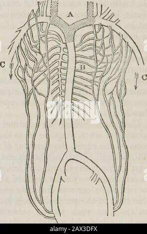 Conférences sur les principes et la pratique de la physique : données au King's College, Londres . A, veines Obstruées. B, siège de l'auricule droite. C, les veines thoracique, pectorales et mammaires transmettent le sang dans un cours contraire à son usualDirection, et anastomosing avec les veines inter-costales et épigastriques. Alors que les veines dans lesquelles les troncs des vaisseaux absorbants distraient leurs tentes étaient oblitérées, il est devenu intéressant d'examiner l'état de ces vaisseaux, et des glandes lymphatiques. Mais la condensation et la confusion de toutes les parties autour de la tumeur ont rendu difficile à tracer Banque D'Images