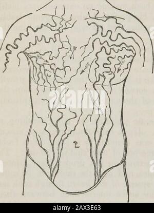 Conférences sur les principes et la pratique de la physique : données au King's College, Londres . ur attention à l'état des theveins. Les deux grands troncs qui, de part et d'autre, s'unissent pour former le supérieur de venacava, ont été complètement fermés, ainsi que la partie correspondante de *He 3k2 714 MALADIES DES VEINES. Cava elle-même, qui a été perdue et confondue dans les murs du sac anévrismal de tne.   les veines de Thesubclavian étaient pervious jusqu'au point où ils ont rejoint les jugu-lars internes, mais pas plus. La préparation de ces parties, qui est devant vous, et therough diagrammes que j'exh ici Banque D'Images