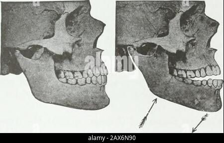 Un traité pratique sur les techniques et les principes de l'orthopée dentaire et de la correction prothétique du palais de fente . CHAPITRE XLV. DIVISION 4. Classe III 319 Fig. 227. Banque D'Images