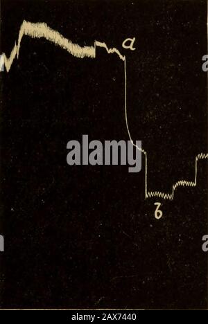 Injection intraveineuse en choc de blessure : étant donné les conférences d'Oliver-Sharpey données avant le Royal College of Physicians de Londres en mai 1918 . arrêté environ trois quarts d'heure plus tard. Wemay note&gt;que cette injection s'est produite en vie et une demi-heure après la blessure, et que, jusqu'à présent, loin de l'acidosisêtre la cause du choc, elle l'a apparemment guéri, tout en la réinhalation l'a amené à nouveau. Anémie Locale. L'une des méthodes de production de choc expérimental est que dans laquelle la circulation est coupée à partir d'une grande partie du corps pendant un certain temps. Admission du sang dans cette zone, une chute de sang Banque D'Images