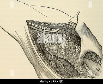 La pathologie et le traitement chirurgical des tumeurs . LA LOGIE ET LE TRAITEMENT DES TUMEURS. La prochaine chose à faire est de dégager la bordure du muscle PEC-toralis inférieur, qui sert en même temps de guide aux vaisseaux axillaires, qui sont les points de repère suivants à rechercher. La veine axillaire peut généralement être trouvée sans difficulté particulière par makinga dissection émoussée avec le doigt, avec le directeur de Kochres, ou avec des ciseaux émoussés. Befoje tout est fait dans l'apex de l'axillaryspace les grands vaisseaux doivent être bien exposés pour éviter les blessures non intentionnelles, ce qui est peu susceptible de se produire Banque D'Images