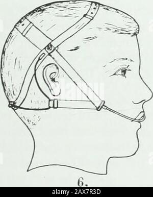 Un traité pratique sur les techniques et les principes de l'orthopée dentaire et de la correction prothétique du palais de fente . Banque D'Images