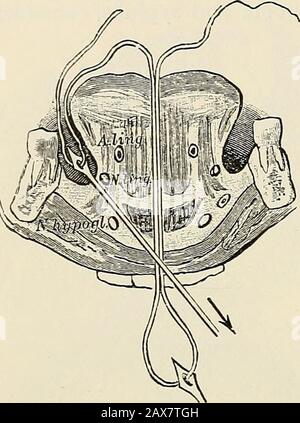 La pathologie et le traitement chirurgical des tumeurs . nodule et fissure de la tongueW. Fairlie Clarke). 292 PATHOLOGIE ET TRAITEMENT DES TUMEURS. Percées dans la ligne médiane près de la pointe avec une grande aiguille armée avec de la soie lourde. Avec ce filetage, qui est attaché à l'extrémité, le timon canbe tiré et maintenu dans n'importe quelle direction pendant l'opération. La prédisposition d'une ou des deux artères linguales comme mesure prophylactique contre l'hémorragie est rarement prise par le prac à l'heure actuelle, et ne doit pas être recommandée. Certains sur-geons emploient l'hémostatique temporaire. Banque D'Images