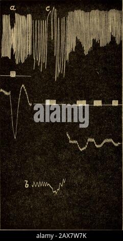 Injection intraveineuse en choc de blessure : étant les conférences d'Oliver-Sharpey données avant le Collège royal des médecins de Londres en mai 1918 . r que le pré-système peut être produit de deux façons. Les endings d'Eitherthe vagus dans les poumons sont anormaux, comme cela peut être le cas après exposition à des gaz irritants surpulmonaires, dans les cas connus d'action asdisordonnée du cœur ou du syndrome de effortT  LW AT  , décrits par Haldane, Meakins, andPriestley (1918); ou, le centre respiratoire peut être anormalement sensible au degré normal d'ostimulation des récepteurs vagus. Cette explication semble Banque D'Images