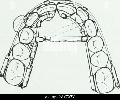 Un traité pratique sur les techniques et les principes de l'orthopée dentaire et de la correction prothétique du palais de fente . Banque D'Images