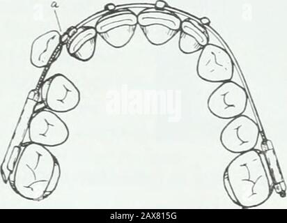 Un traité pratique sur les techniques et les principes de l'orthopée dentaire et de la correction prothétique du palais de fente . Banque D'Images