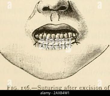 La pathologie et le traitement chirurgical des tumeurs . structure ical de l'existingaffection, et ce dernier donnera des résultats positifs si la lésion est tuber-circulaire, et négative si c'est un carcinome. Traitement opératoire de Carcinoina du Lip.—Les meilleurs résultats curativeet cosmétiques sont obtenus par excision précoce et complète.Si la tumeur est petite, l'opération peut être faite sans anesthésie;si grande et si une opération plastique doit suivre pour corriger le défaut,l'anesthésie partielle répondra à l'objectif. L'artère coronaire doit être comprimée aux deux angles de la bouche par compression-forceps ou Banque D'Images