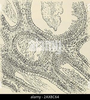 La pathologie et le traitement chirurgical des tumeurs . stroma. Pour induire de nombreux auteurs à la considérer comme une forme spéciale de tumeur.Lebert a montré que ce qui était connu sous le nom de carcinome colloïdal est un carcinome de voiture-cinoma modifié par le caractère de la métamor-métamorphose de tissu régressif de ses cellules ou de son stroma, ou les deux. La dégénérescence des colloïdes est souvent fréquente dans le carcinome du canal alimentaire, la localité préférée de ce qui était décrit précédemment comme un cancer du colloïde (Fig. 144). La dégénérescence mucoïde ou myxomateuse peut se produire dans le violoncelleur le stroma d'un carcinome. Le carcinome à cellules columnaires est très aptto Banque D'Images