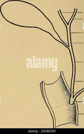 Les calculs biliaires et les maladies des canaux biliaires . Fig. 1.—Section transversale d'un canal portail. (Après Schafer.) dans la deuxième partie du duodénum. Les largoulottes et la vésicule biliaire constituent les excrétoryappareils du foie et sont de cette importance que chacun exigera une description détaillée. L'appareil excrétoire du foie.—Ce consistresdu conduit hépatique, du conduit cystique, de la vésicule biliaire et du canal biliaire commun (Fig. 2). Le conduit hépatique, formé par l'Union des 4 MALADIES DU canal hépatique droit et gauche, a un diamètre moyen de 4 mm, et en longueur varie fr Banque D'Images
