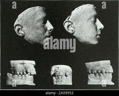 Un traité pratique sur les techniques et les principes de l'orthopée dentaire et de la correction prothétique du palais de fente . et l'alignement des cuspides. Le molaire inférieur malade a également été extrait, car aucune dentistine capable de ces jours-ci tenterait de le restaurer. À l'exception des appareils pour le mouvement mésial corporel du deuxième molaire pour fermer l'espace du premier molaire extrait, le cas aurait été corrigié s'il était donné le temps vmder circonstances ordinaires. Il a été havisé avec un appareil supérieur ayant un arc résistant pour les mouvements cuspides, et la force intermaxillararyforce pour ajuster le Banque D'Images