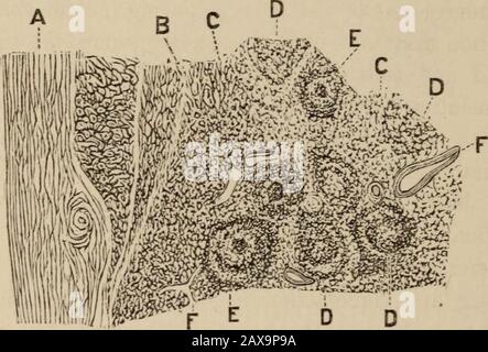 Revue médicale de Chicago et examinateur . nnective tissu net-travail avec des maillages ronds ou ovales,remplis de cellules lymphoïdes et de noyaux. Il contient de nombreux vaisseaux sanguins avec des W^alls minces, dont les alcôats sont transformés en ou participent à la forma-tion des branches du réticulum. Cette structure-likestructure-énoïde du tissu conjonctif autour des tubercules que nous avons fondateurs dans tous les cas. [La même structure peut être trouvée dans le jeune con- 470 Lee-Fenger, Select Topics of Modern Surgery. [Mai, tissu nécrosif, dont la formation ne joue aucun rôle dans le tubercule de grognement.] Il pousse entre le pain Banque D'Images