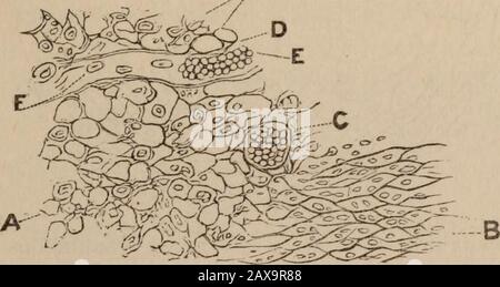 Revue médicale de Chicago et examinateur . le réticulum de la partie centrale du tubercule. Le réticulum de la cellule géante. Fig. 1. 6, forme un filet-travail avec de grands maillages ronds ou irréguliers. Beaucoup des maillages sont vides, c'est-à-dire ne contiennent pas de cellules, mais sont remplis de fluide transparent. Dans quelques-uns des maillages se trouvent de grandes cellules épithéliales avec un protoplasmique clairement visible et un noyau rond ou ovale bien défini. Un grand nombre de maillages- 1880.] Lee-Fenger, sélectionnez sujets de chirurgie Moderne. 469 contiennent deux, trois ou plusieurs petites cellules ou noyaux lymphoïdes, dont le manyde est élevé Banque D'Images