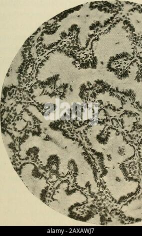 La pathologie et le traitement chirurgical des tumeurs . Fig. 89.—Adénome du foie (après Paul): A, section de conduit aveugle remplie de fluide vert : b, cellules du foie; c, tissu conjonctif. Composé de cellules épithéliales columnaires. Petite adénomata, composée de cylindres bordés par l'épithélium cylindrique et incrustés dans des tissus fibreux,. Banque D'Images