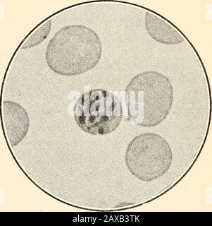 Les fièvres malariaux, la fièvre hémoglobinurique et les protozoaires sanguins de l'homme . Fig. 7.—Plasmodium malarias. (QuartanPlasmodium.) Parasite Sporulant.Photomicrograph, X 1200. Fig. 8.—Plasmodium malarias. (QuartanPlasmodium.) Sporulating parasiePhotomicrograph, X 1800. Le même arrangement de pigment dans les formes de segmentation tertienne; il est probablyd'occurrence accidentelle, sans doute plus commun dans le quartan plasmodium, mais pas du tout propre à l'espèce. Réactions de coloration de Plasmodium Malariae.—la structure de PlasmodiuMi malariae, le parasite malarique du quatuan, comme le montre Wrights 30 L'ETIOLO Banque D'Images