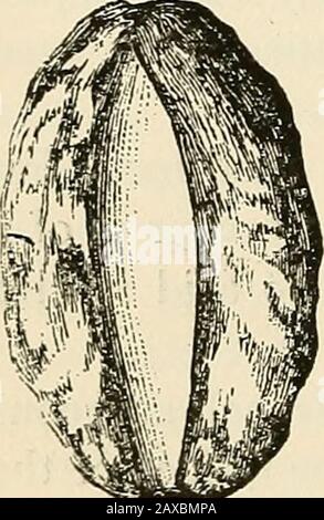 La pathologie et le traitement chirurgical des tumeurs . esthétique a été administré, les pansements ont été enlevés, le cou a été désinfecté, et l'artère carotidienne commune a été liée. Lors de l'examen de la grande surface partlycouverte par des granulations et en partie par des carcinomes-tissus fongibles, l'ouverture de l'alarge dans l'artère carotide externe a été trouvée près de la bifurcation de la carotide commune. La surface a été désinfectée et la théouvence dans le navire a été tampée avec de la gaze iodoforme. L'orrhage n'est pas retourné, et le patient a quitté l'hôpital dans la cour d'une semaine. Suppression immédiate et complète d'une tumeur Banque D'Images