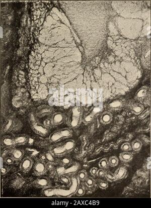 Transactions de la Société médicale homéopathique de l'État de Pennsylvanie . Dépôt inflammatoire à la surface de l'ovaire.Multiplié par 200 diamètres. Fig. 7.. Gyroma de l'ovaire ; également multiplié et malades vaisseaux. MuHinlieri no (liRnioters. Fig. 6. Banque D'Images