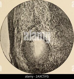 Transactions de la Société médicale homéopathique de l'État de Pennsylvanie . Ovaire d'un enfant de 3 ans. Multiplier 50 diamètres. Fig. 2.. Ovule en maturation près de la surface de l'ovaire, montrant le granulosa du souvenir.Multiplié 150 diamètres. Fig. 3. Banque D'Images