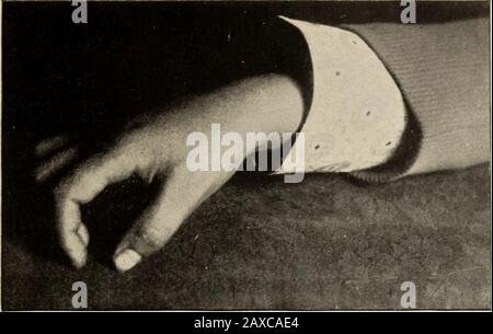 Transactions de la Société médicale homéopathique de l'État de Pennsylvanie . transmises à l'hôpital le 26 octobre. S'est plaint de beaucoup de douleur, depuis le dernier de-cember, dans l'articulation du genou; a été au lit pendant huit mois, douleur en sortie de gradé-allié; l'immobilité presque complète de l'articulation du genou et de la cheville. Nous avons essayé d'étendre au moyen de la sprint postérieure après l'exten-sion du membre a été effectuée; nous avons utilisé des fomentations, mais sans résultat. Une opération a été effectuée le 4 février 1893, l'articulation étant réséquée selon la méthode habituelle et la sameline du traitement effectuée comme indiqué ci-dessus Banque D'Images