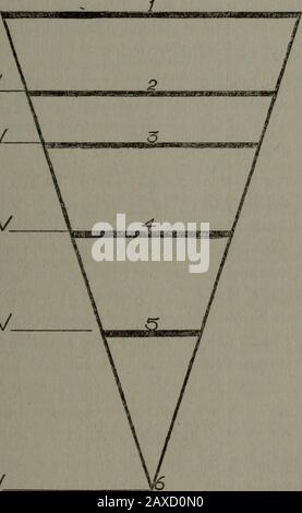 La revue médicale Cleveland . PS 4/YOA/ N^-o/pct/ss- i/opjs/bSized Diagram III Cesarean section une procédure de grand danger pour la mère et de valeur douteuse pour l'enfant après une tentative de forceps. Au cours de la dernière année, j'ai eu deux cas d'illustration du risque théérieux de dommages maternels impliqués dans la forceps application à la station I. Mme X. Primipara, dans les soins d'une sage-femme, qui a appelé aphysicien en raison du manque de progrès du travail. Le médecin Ske€l—Station in Labour 125 a appliqué les pinces mais n'a pas réussi à délivrer. Lors de l'examen à l'hôpital, j'ai trouvé le patient saignant librement; p Banque D'Images