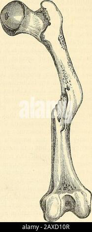 Un traité pratique sur les fractures et les dislocations . Fracture de la cuisse d'une dinde; unie avec les frag-ments largement séparés. D'un spécimen dans l'authorscabinet. Union. Ce mode d'Union est parfois becompillée lorsque les deux extrémités des os sont séparées plus tard qu'un pouce ou plus l'un de l'autre.J'ai dans ma collection l'os de la cuisse des touches (Fig. 3) donc arbre osseux transversal de bya uni, bien que classé sepa de plus d'un pouce; et ce qui est moins commun, je possède aussi une spécialité de la cuisse humaine adulte (Fig. 4), dans lequel un arbre oblique de callusshas solides, après de nombreux mois, a Banque D'Images