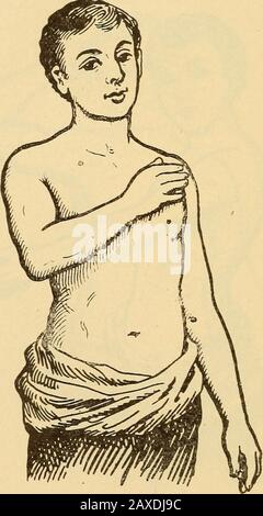 Conférences sur la chirurgie orthopédique . Fig. 187.—Peut facilement pousser le bras vers l'avant. Ward. Le patient trouve qu'il ne peut pas quand la commode derrière lui et ajuster ses vêtements avec la liberté et la dextérité accus-tomed, et le bras est heldhugged sur le côté. La diminution précoce des muscles comeson est un symptôme constant; la sensibilité topresssure peut être trouvée sur l'aspect antérieur extérieur 228 de la tête de l'humérus, et la douleur peut être com-plinée de à l'insertion du deltoïde. Les progrès de la maladie, à moins d'être aidés par l'art, sont de mauvais à pire.Les complications sont l'abcès et la subluxation. Thetend Banque D'Images