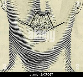 Manuel de médecine générale . Fig. 484^. Procédé de brans. Cou, et les procédés moins déviants réguliers auto iîs varient pres-quà chaque malade.] VII. — Chéliloplàstie de la lièvre supérieure. Le cancer est infinitif moins fréquent à cette lièvre à lau-tre ; de là la ratée des opérations à pratiquer sur ce point, et la. Banque D'Images